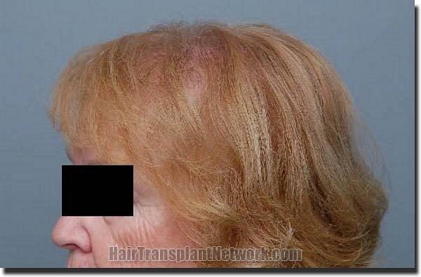 Hair restoration procedure results