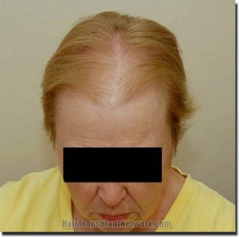 Hair restoration procedure results