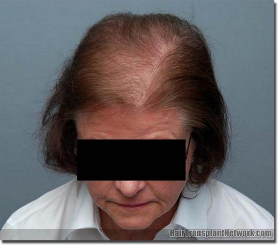 Hair restoration procedure results