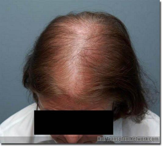 Hair restoration procedure results