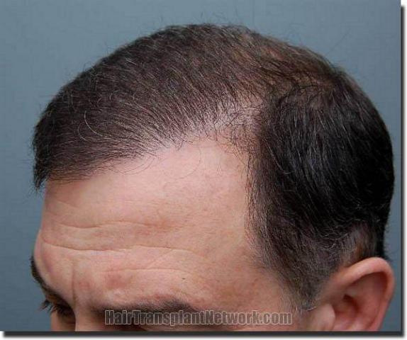 Hair restoration procedure results