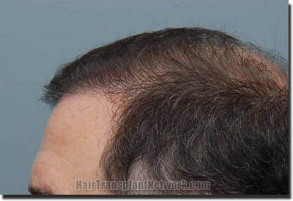 Hair restoration procedure results