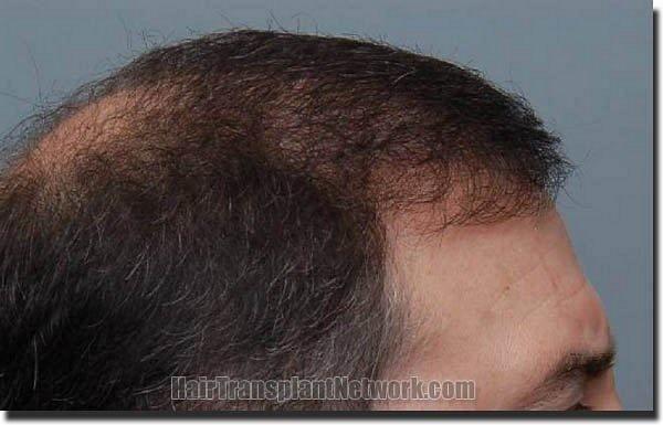 Hair restoration procedure results