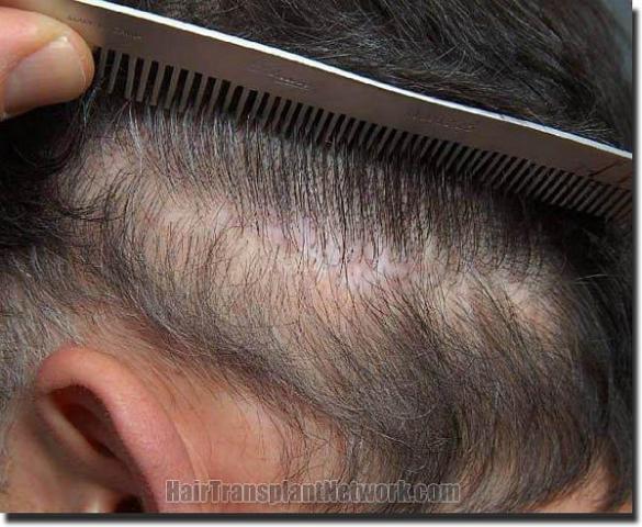 Hair restoration procedure results