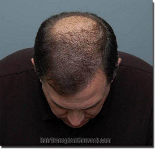 Hair restoration procedure results