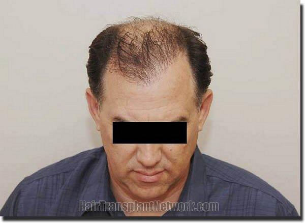 Hair restoration procedure results