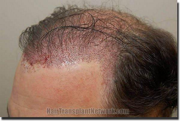 Hair restoration procedure results