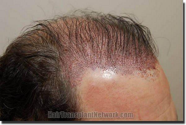 Hair restoration procedure results