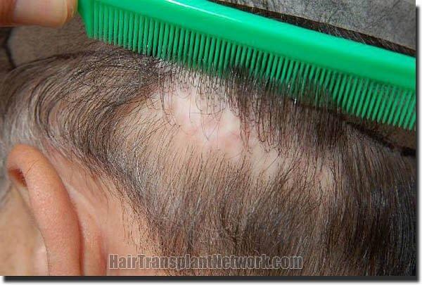 Hair restoration procedure results