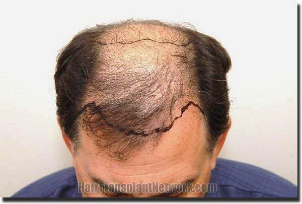 Hair restoration procedure results