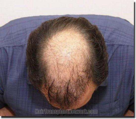 Hair restoration procedure results