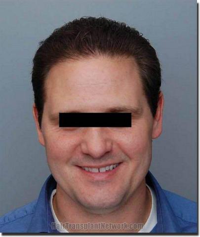 Hair restoration procedure results