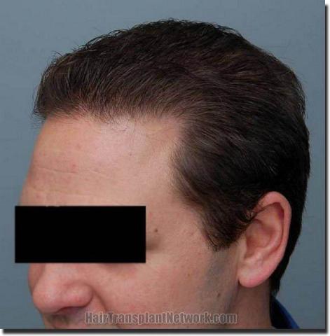 Hair restoration procedure results