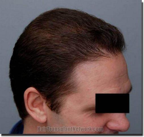 Hair restoration procedure results