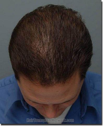 Hair restoration procedure results