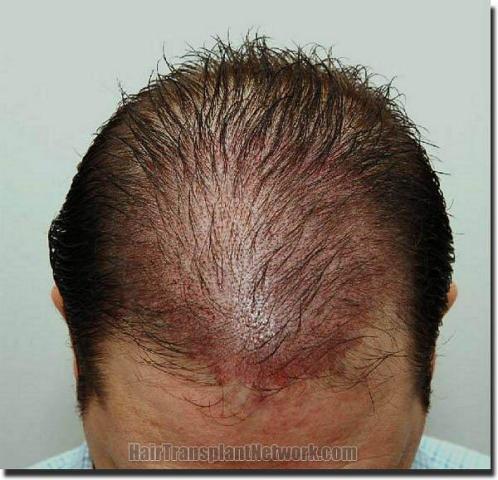 Hair restoration procedure results