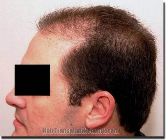 Hair restoration procedure results