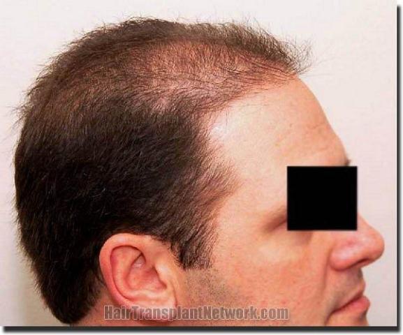 Hair restoration procedure results