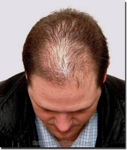 Hair restoration procedure results