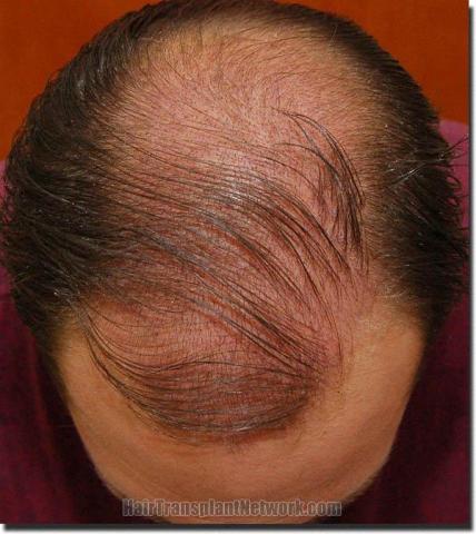 Hair restoration procedure results