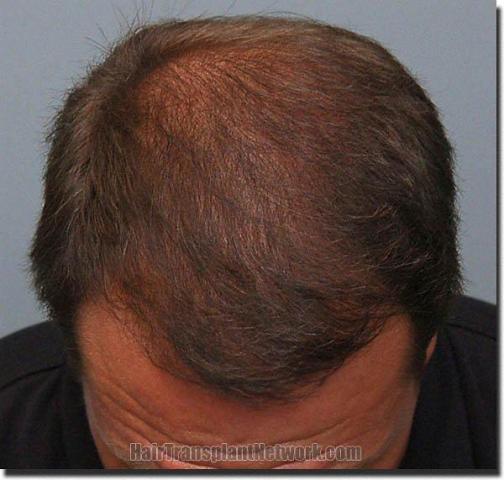 Hair restoration procedure results