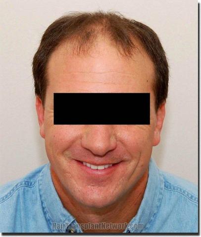 Hair restoration procedure results