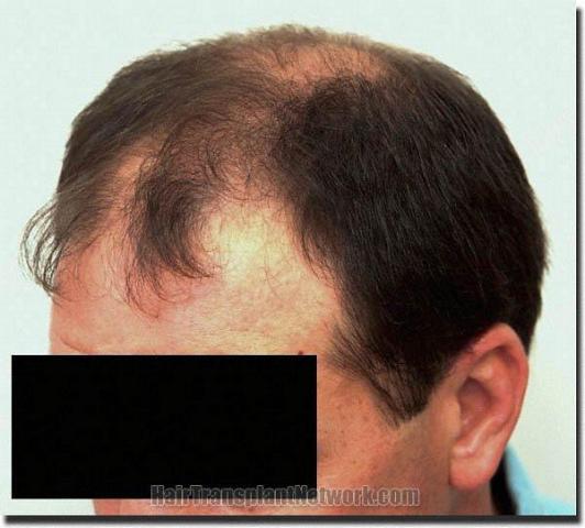 Hair restoration procedure results