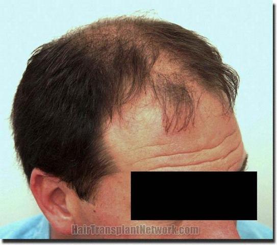 Hair restoration procedure results