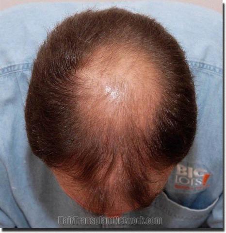 Hair restoration procedure results