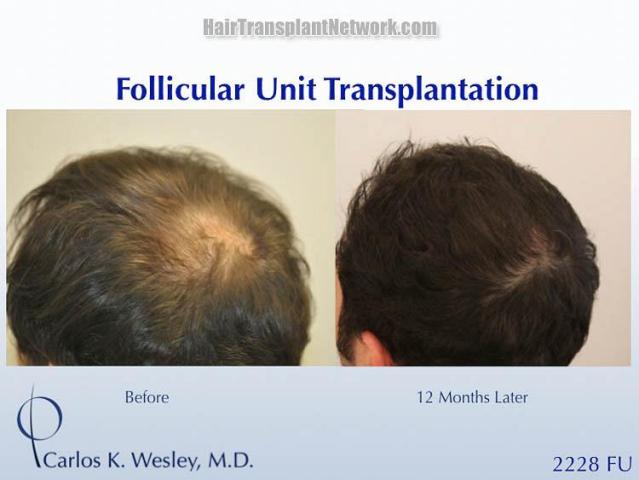  Before and after hair transplant surgery result images