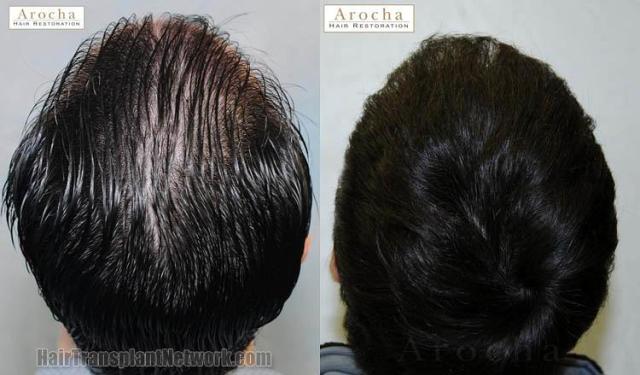 Hair restoration procedure before and after pictures