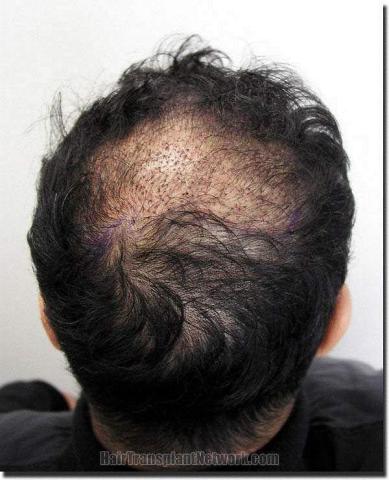 Hair restoration procedure results