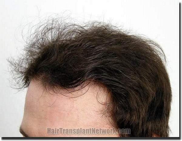 Hair restoration procedure results