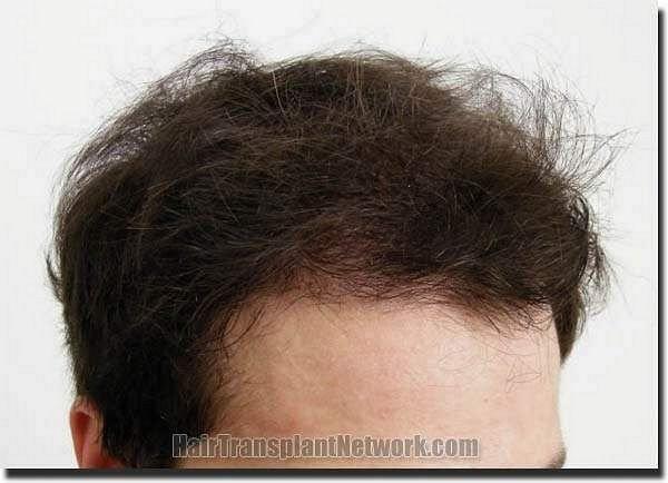 Hair restoration procedure results