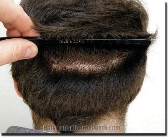 Hair restoration procedure results