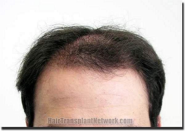 Hair restoration procedure results