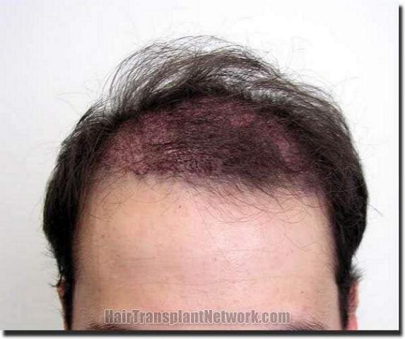 Hair restoration procedure results