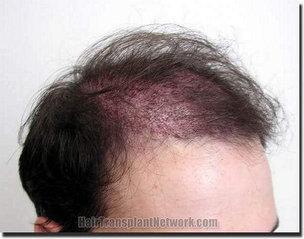 Hair restoration procedure results