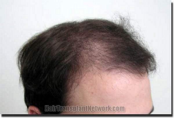 Hair restoration procedure results