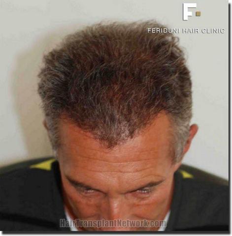 Hair restoration procedure results