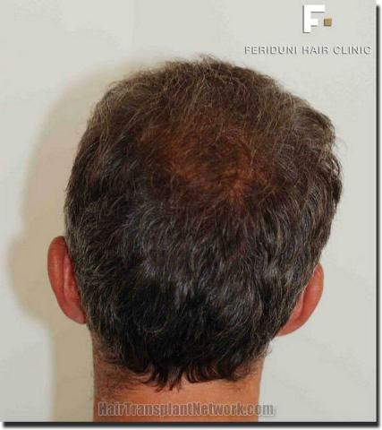 Hair restoration procedure results