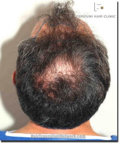 Hair restoration procedure results