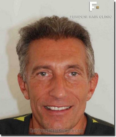 Hair restoration procedure results