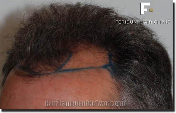 Hair restoration procedure results