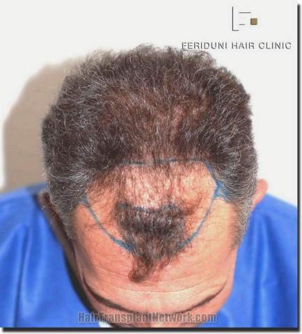 Hair restoration procedure results