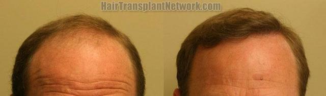 Before and after hair restoration procedure photos