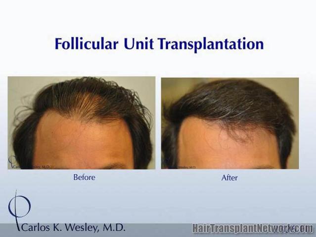 Hair transplantation surgery before and after pictures