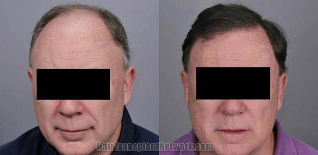 Hair restoration procedure before and after results