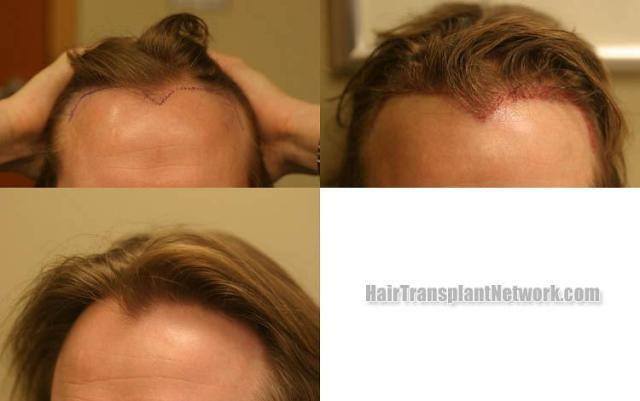 Hair transplantation surgery before and after images