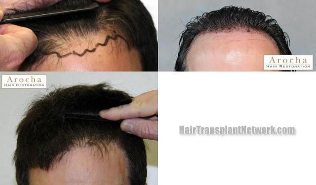 Hair restoration procedure before and after results